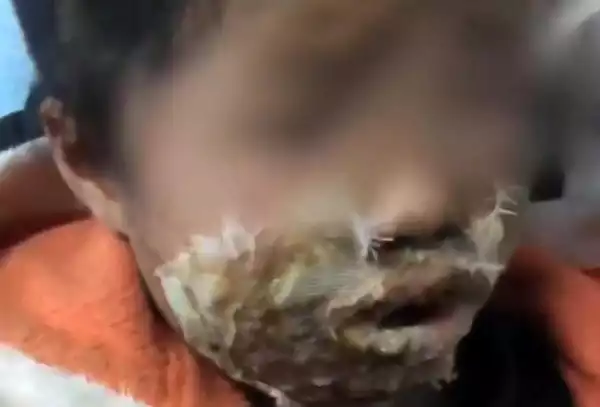 Horror! Samsung Phone Explodes Next to Little Girl While She Slept Leaving Her Seriously Burnt (Photo)